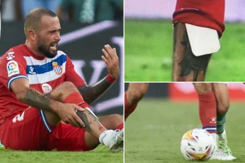 Φρικιαστικός τραυματισμός του Βιδάλ – Φορούσε επικαλαμίδες από χαρτόνι (pic)