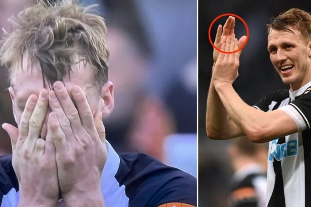 Νιουκάστλ: Η τραγική ιστορία πίσω από χαμένο δάχτυλο του Νταν Μπερν