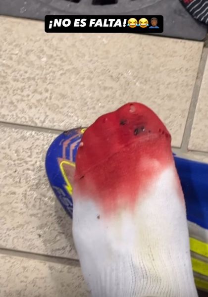 Ιδού η φωτογραφία με το ματωμένο πόδι του Λαμίν Γιαμάλ, μετά το εκτός έδρας ματς της Μπαρτσελόνα με τη Λας Πάλμας: